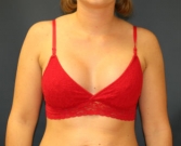 Feel Beautiful - Breast Implants San Diego 62a - After Photo